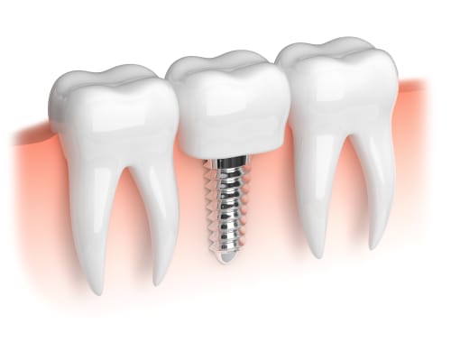 Dental Implants, Ottawa Dentist